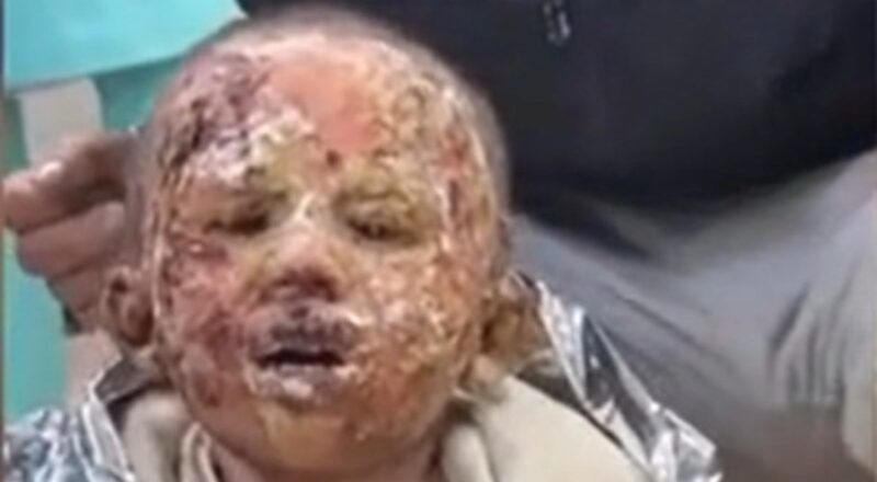 1710892867 Gazzede kimyasal silahla yaralanan kucuk kizin cigliklari yurek yakti